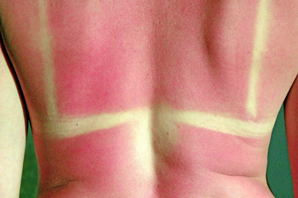 les tan lines augmentent le risque de cancer de la peau